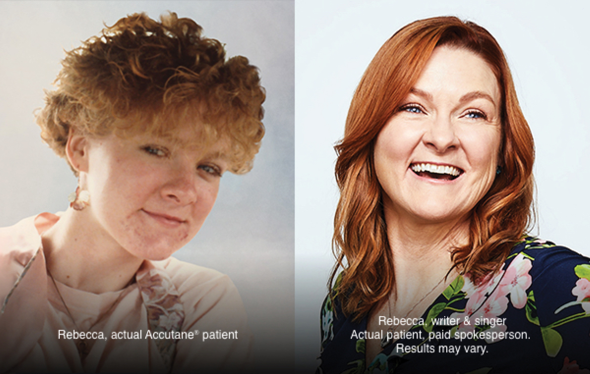 Rebecca, actual Accutane ® patient | Rebecca, writer & singer Actual patient, paid spokesperson.  Results may vary.